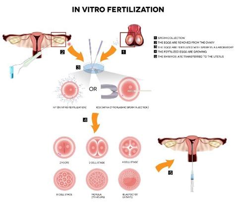 In Vitro Fertilization Dfw Center For Fertility And Ivf