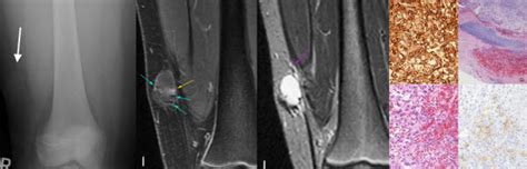 Angiomatoid Fibrous Histiocytoma A Case Report And Review Of The