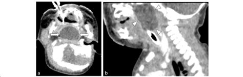 Contrast Enhanced Computed Tomography Ct Scan Of The Airway A Axial