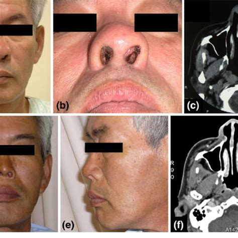 Case 1 A B A Tumor Was Seen On The Left Medial Nasal Vestibule And