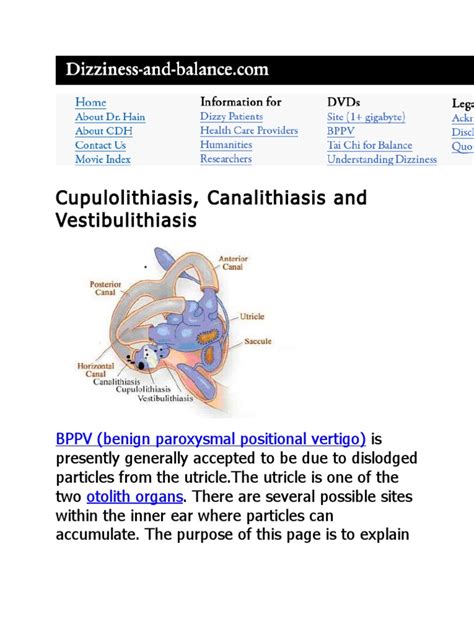 Cupulolithiasis Diseases And Disorders Human Head And Neck