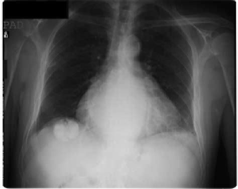 Chest Radiograph Disclosed A Rounded Calcified Opacity In Right Upper