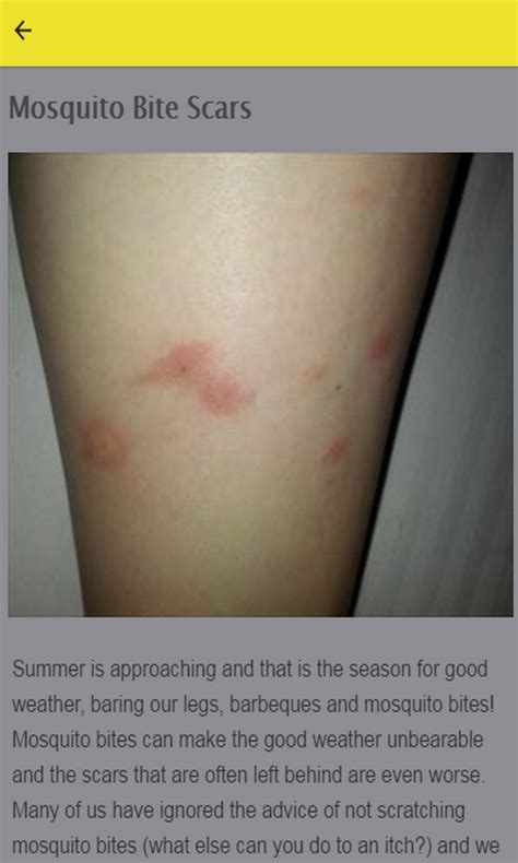How To Get Rid Of Mosquito Bites Ubicaciondepersonascdmxgobmx