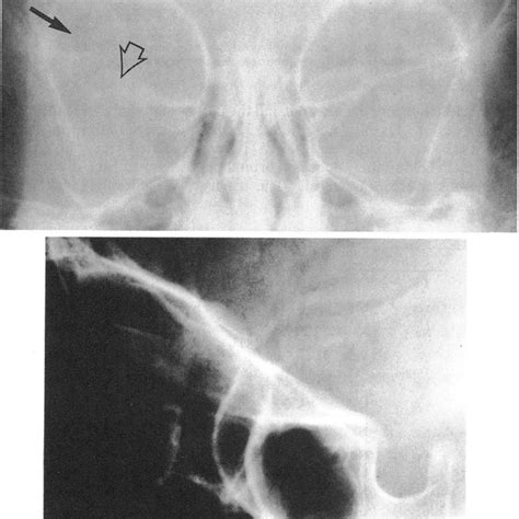 Pdf Aneurysmal Bone Cyst Of The Sphenoid With Orbital Involvement