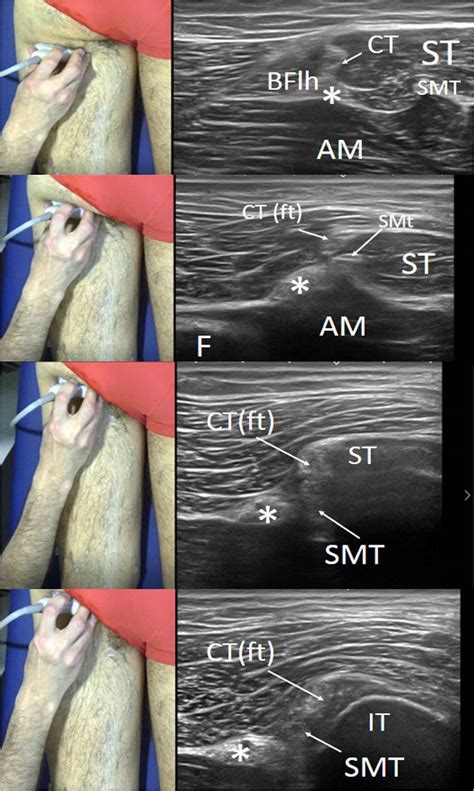Introduction To Diagnostic Ultrasound Of Hamstring Muscles Sports
