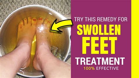 Edema 5 Natural Remedies For Swollen Feet And Ankles By Top 5 Youtube