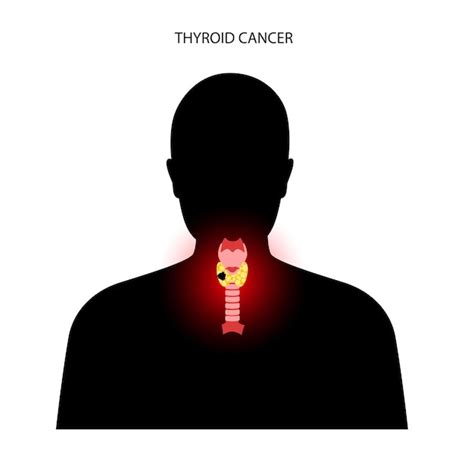 Premium Vector Thyroid Cancer Stages
