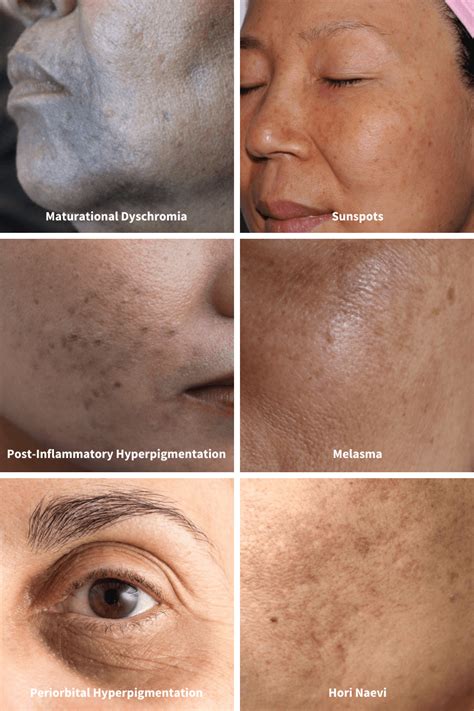 Hyperpigmentation Journey To Being Spot Free Its Thy Time