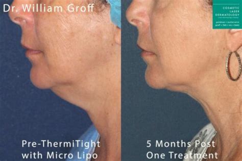 5 Fixes For A Sagging Chin Cosmetic Laser Dermatology Skin