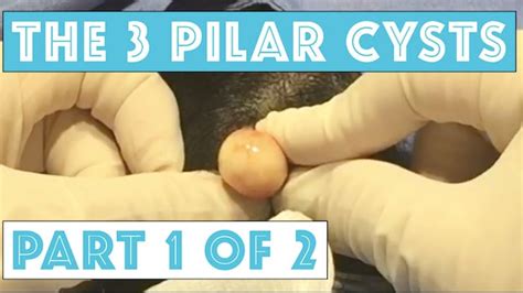 Cystactular Cysts Dr Pimple Popper