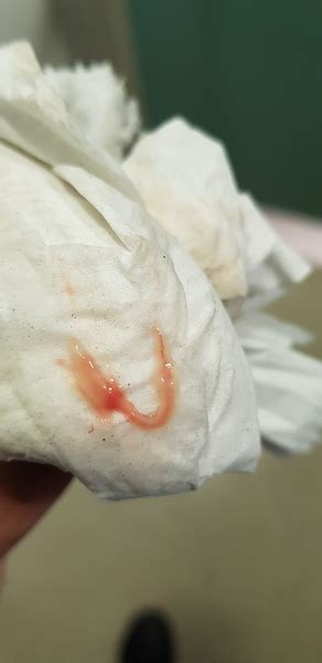 Is This Implantation Bleeding Mumsnet