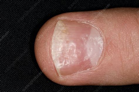 Psoriasis Of The Fingernail Stock Image C0072739 Science Photo
