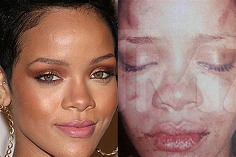 Rihannas Battered Face Leaked Picture Shows Injuries After Alleged Assault By Chris Brown