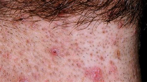 Infected Ingrown Hair Pictures Treatment Removal And More