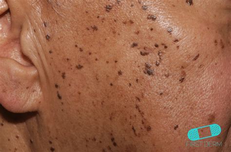 10 Most Common Black Skin Conditions And Their Treatment First Derm
