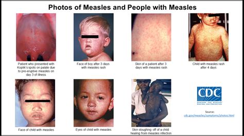 Measles Lake County General Health