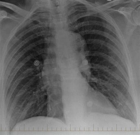 Ap Chest Radiograph On Admission Arrow Indicates Intimal Calcification