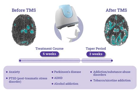Tms Therapy A Non Invasive Treatment For Depression And Anxiety