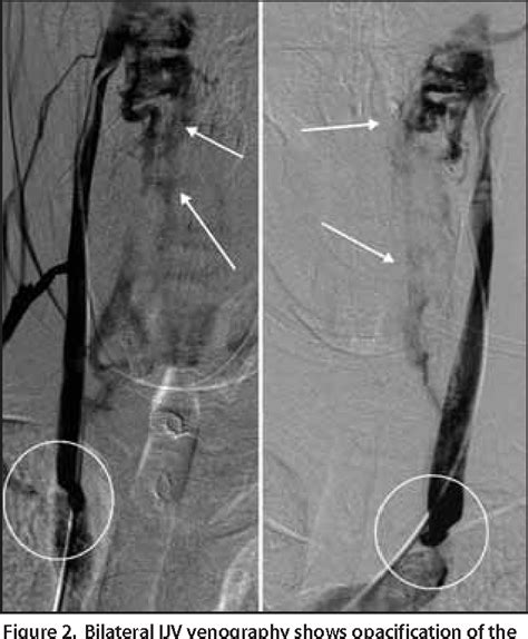 Figure 2 From Chronic Cerebrospinal Venous Insufficiency A New Paradigm