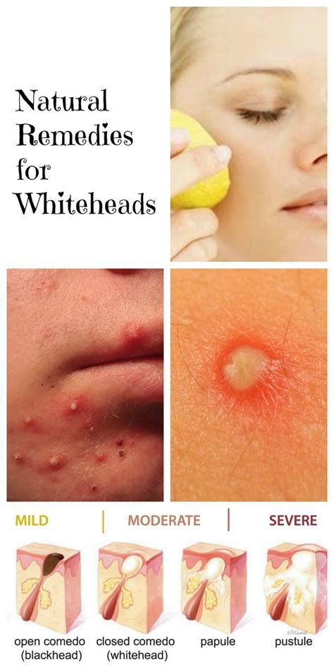 Whiteheads Are Small Exhausting White Or Yellowish Bumps Might Be