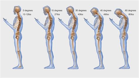 Text Neck Syndrome Signs Symptoms And Solutions