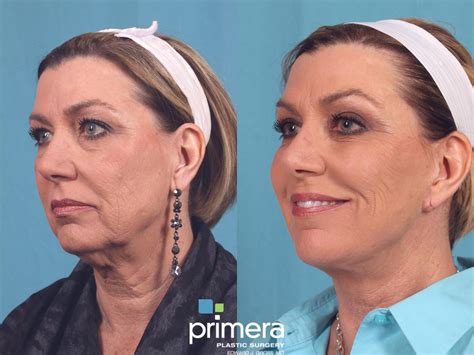 Blepharoplasty Before And After Pictures Case 257 Orlando Florida