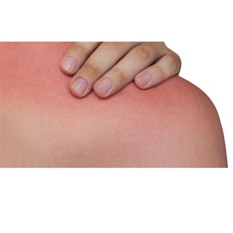 Understanding Sunburns Unveiling The Science Behind Skin Damage Medino