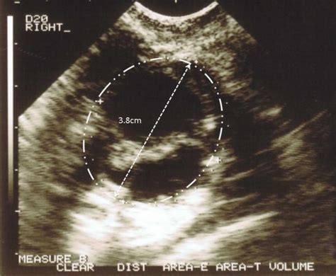 Transvaginal Ultrasound Image Of Septated Right Ovarian Cyst In Ivf