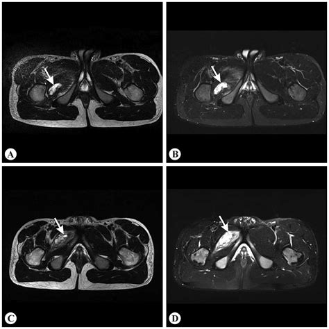 Bilateral Recurrent External Obturator Muscle Hematoma An Unusual