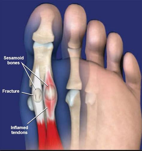 Sismoid Bone Computed Tomography Shows Fracture Of Sesamoid Bone A