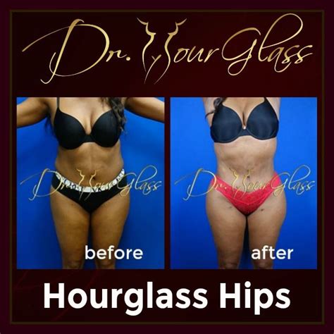 Sharing You Another Result Of Hourglasships Procedure By Drhourglass