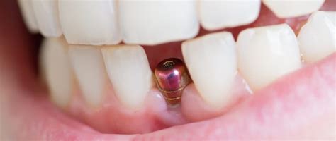 How The New Minimidi Implant Dental Technology Can Help Your Smile