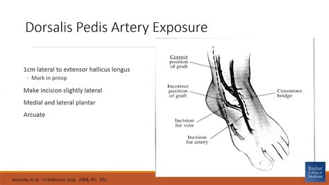 Dorsalis Pedis Artery Exposure How I Do It Youtube