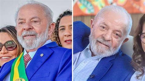 Veja Antes E Depois De Lula Após Cirurgia Plástica