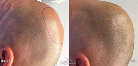 Occipital Surgery For Flat Spots On Head Dr Barry L Eppley