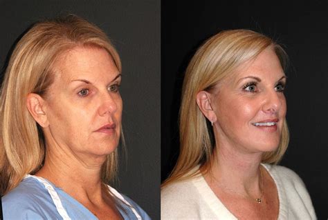 Deep Plane Facelift Before And After Dr Andrew Jacono In 2021 Deep