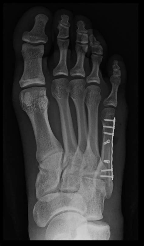 Comparison Of 2 Oblique Fifth Metatarsal Osteotomies For The Management