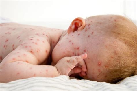 Small Baby With Red Spots On Face Arms And Body Red Spots On Face