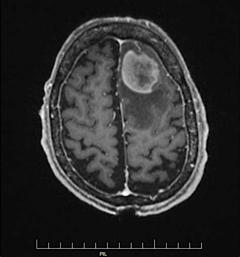 Cureus Primary Central Nervous System Lymphoma With Systemic Recurrence