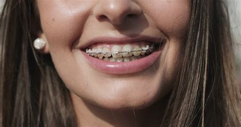 Orthodontic Braces Stock Video Footage 4k And Hd Video