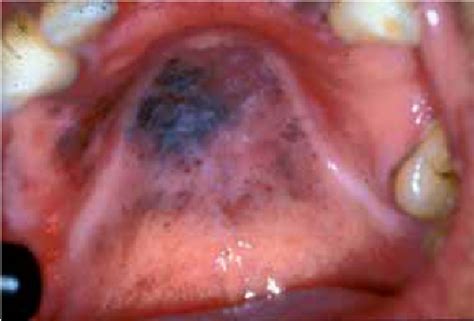 Clinical Case 4 Clinical Description Tumor In Hard Palate Left Side