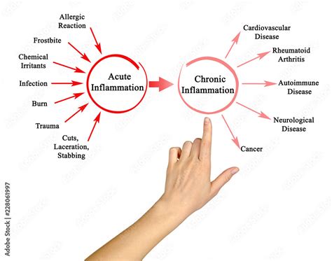 Acute And Chronic Inflammation Stock Photo Adobe Stock