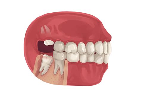 How To Manage A Broken Wisdom Tooth Causes Risks And Treatment
