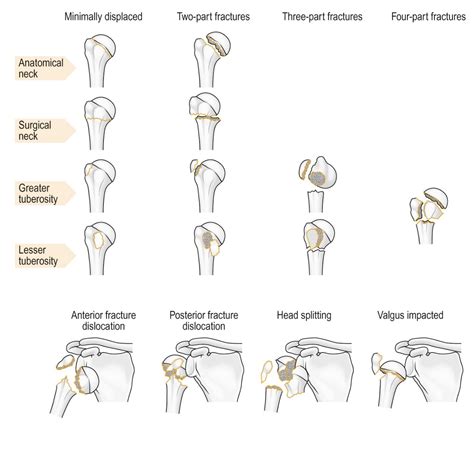 Diagram Of Neers Classification Of Proximal Humerus F Vrogue Co
