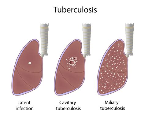 Tuberculosis Pulmonar Vrogue Co