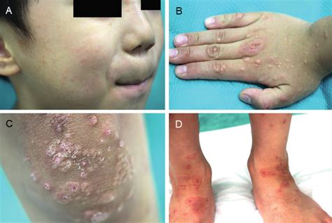 Clinical Findings A Scattered 1 To 3 Mm Erythematous Papules On The