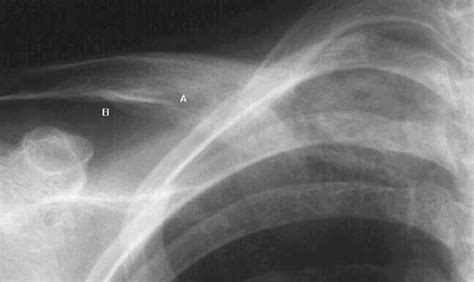 Acute Osteomyelitis Of Right Clavicle Subcortical Scalloping A And