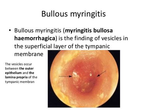 Infectious Myringitis Pictures