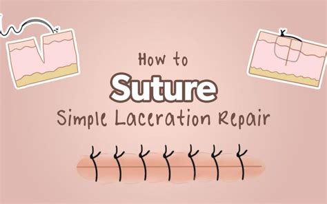 How To Suture Simple Laceration Repair Health And Willness Sutures