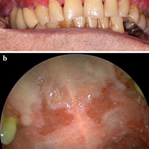 A Mmp Of Nasal Mucosa Involvement With Crusting And Erosions B Mmp Of